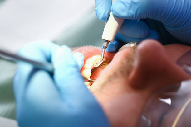 Best Emergency Root Canal Treatment in Troutdale, OR