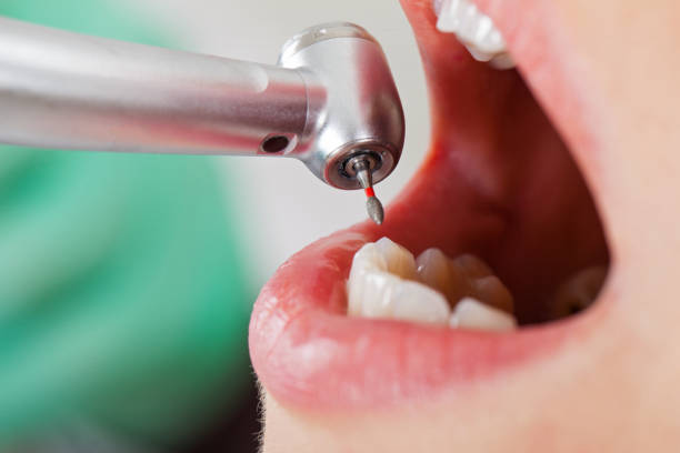 Best Emergency Dentist for Knocked-Out Tooth in Troutdale, OR